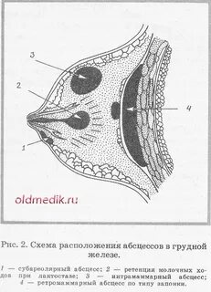 Абсцесс железы