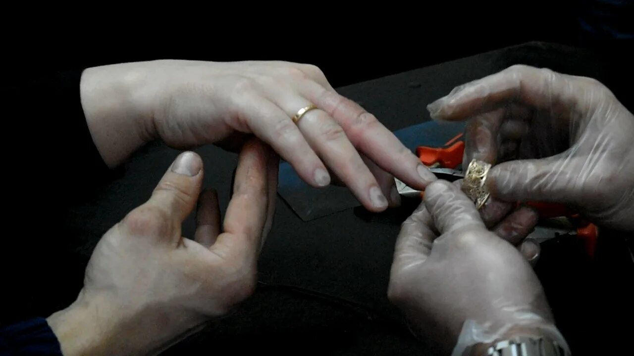 Снятие колец с пациента. Как снять кольцо с опухшего пальца. Нападение пальца