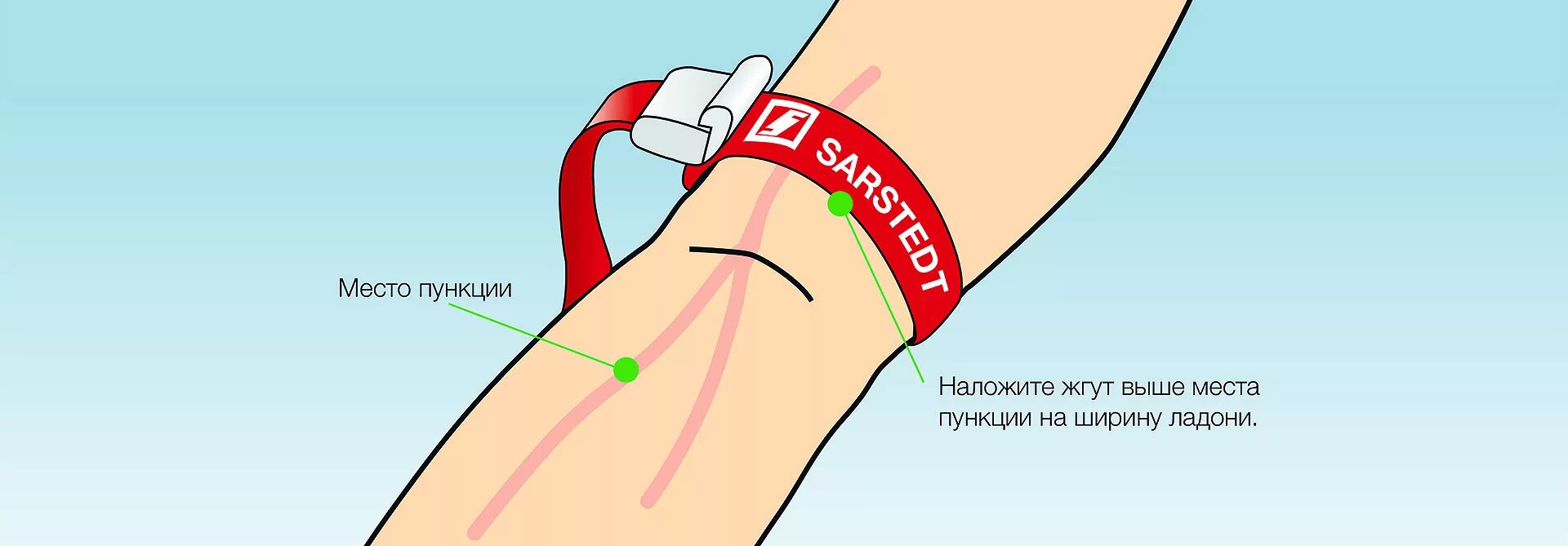 Схема остановки кровотечения. Жгут на вену. Кубитальный периферический катетер. Жгут на вену. Наложение жгута при внутривенной инъекции.