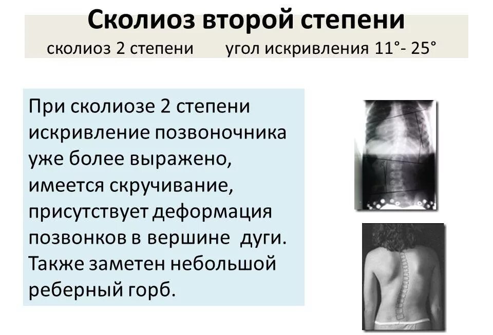 Сколиоз 2 степени это. Сколиоз 2 степени угол искривления. Сколиоз 1-2 степени у ребенка. Структуральный сколиоз 2 степени. Угол искривления при сколиозе 2 степени.