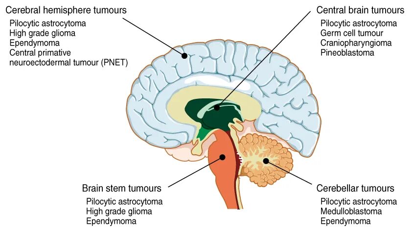 Рак ствола головного мозга. Опухоль головного мозга мозжечка. Опухоль червя мозжечка. Опухоль ствола головного мозга. Опухоли полушарий мозжечка.
