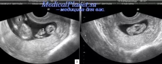 Плод в полости матки. Фето-фетальный трансфузионный синдром (ФФТС). Амниотический тяж в полости матки. Синдром фето-фетальной гемотрансфузии УЗИ.