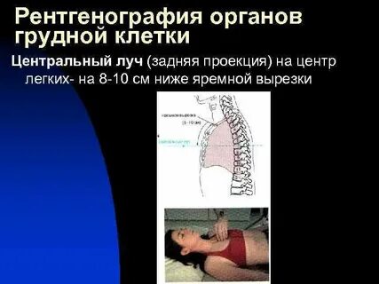 Рентген грудины укладка