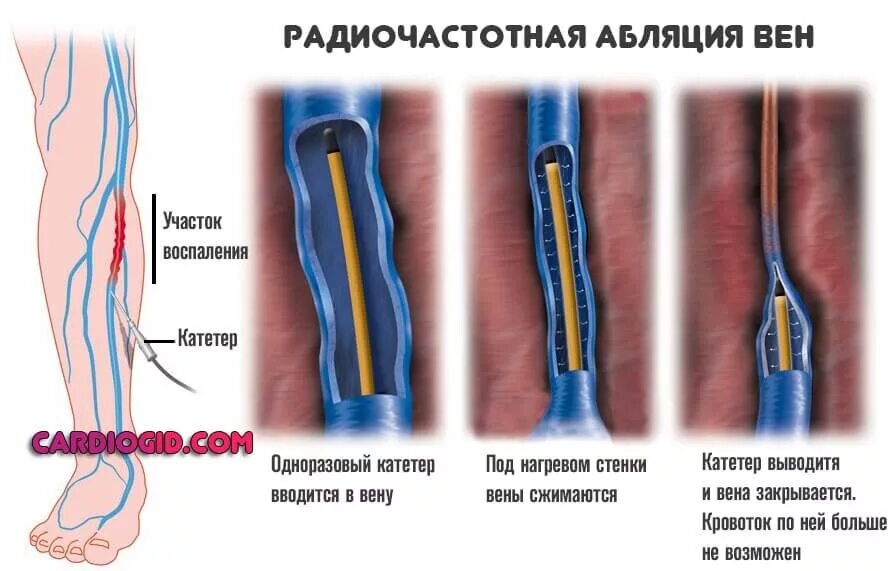 Радиочастотная облитерация (РЧО) вен нижних конечностей. Высокочастотная абляция вен нижних конечностей. Радиочастотная абляция варикоза.