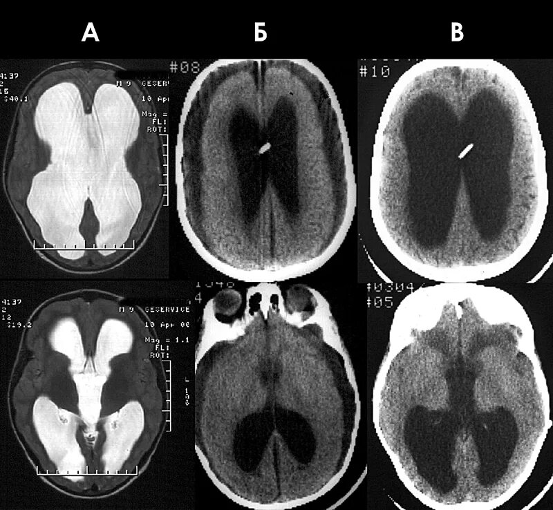 расширение субарахноидального пространства кт.