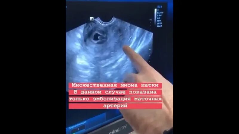 Тянет живот при миоме
