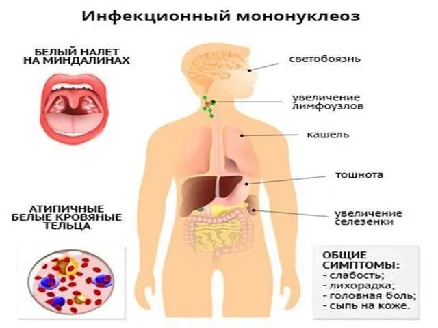 Мононуклеоз у взрослых что это за болезнь. Вирусный мононуклеоз симптомы. Инфекционный мононуклеоз симптомы сыпь. Терапия при инфекционном мононуклеозе у детей. Мононуклеоз Эпштейн Барра осложнения.