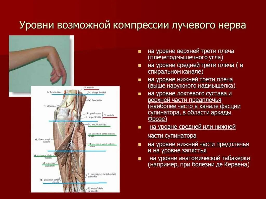 Повреждение лучевого нерва. Уровни компрессии лучевого нерва. компрессия лучевого нерва на уровне спирального канала. симптомы повреждения лучевого нерва на уровне плеча. клинические проявления нейропатии лучевого нерва.