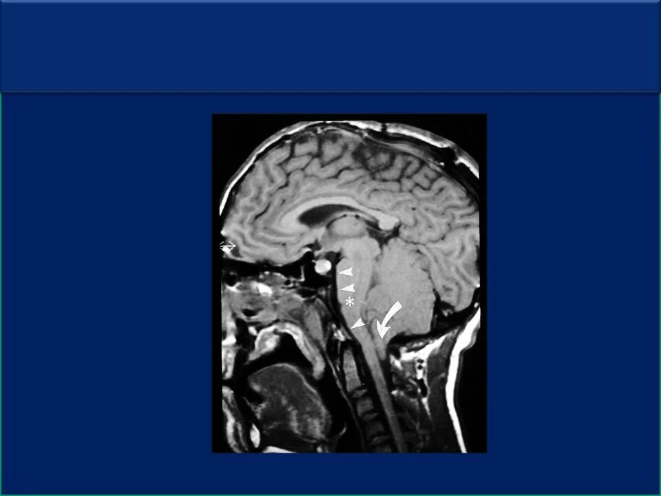 Вклинение миндалин мозжечка. Вклинение ствола головного мозга кт. Вклинение миндалин мозжечка в большое затылочное отверстие кт. Вклинение ствола головного мозга в большое затылочное отверстие. Мозжечковая опухоль