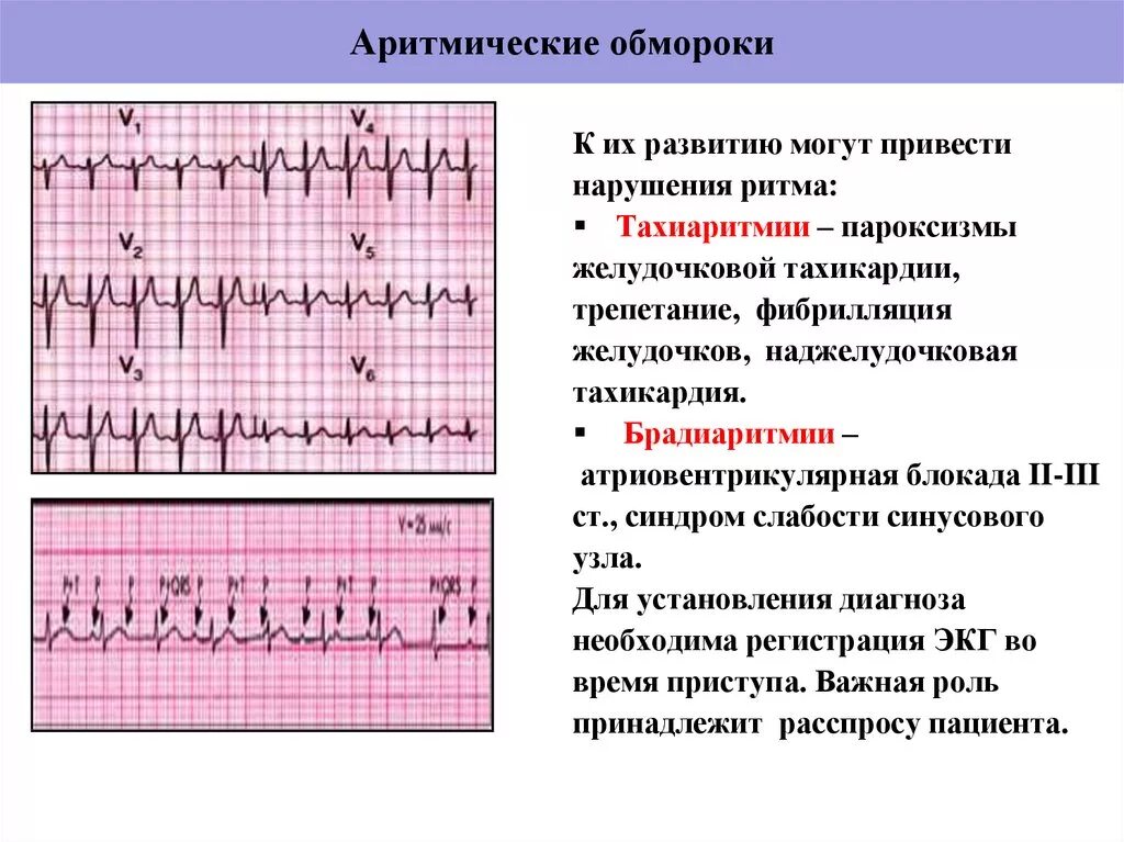 ЭКГ проявления синусовой тахикардии. ЭКГ при синусовой брадиаритмии. Синусовая брадикардия на ЭКГ. Синусовая тахикардия ЭКГ признаки.