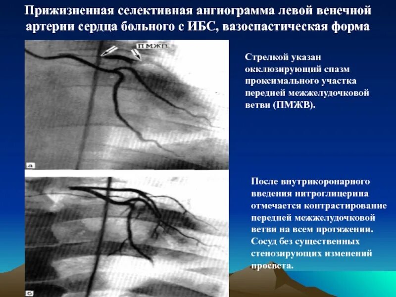Атеросклероз левой коронарной артерии. Чреспищеводная коронарография. венечные артерии ангиограмма. коронарография атеросклероз. ангиограмма сосудов сердца.