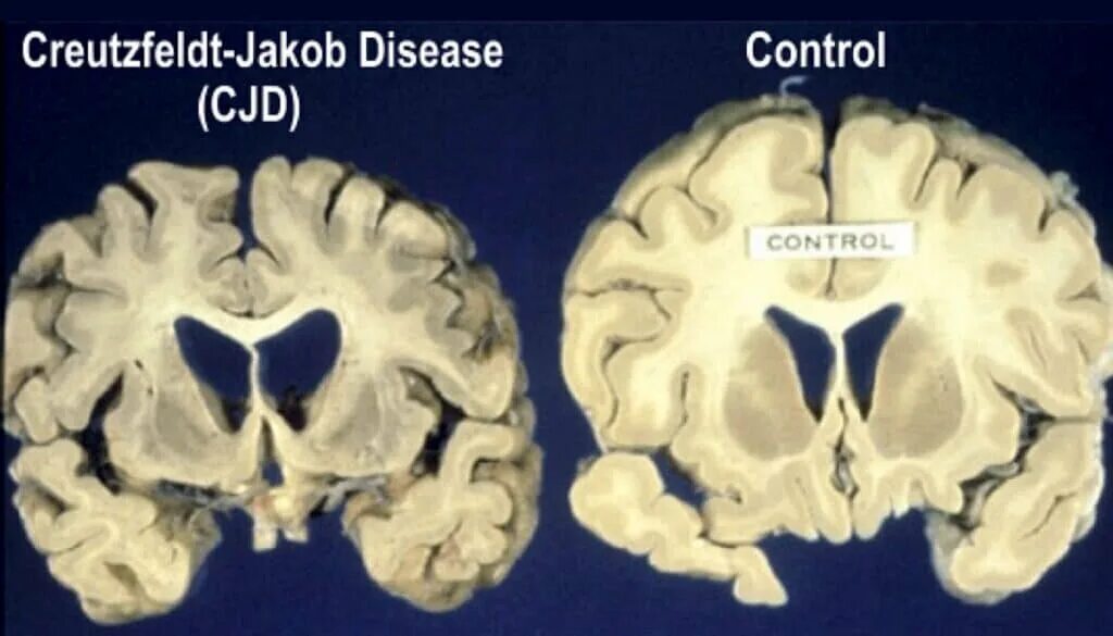 Прионы куру крейтцфельдта-якоба. 6 the disease. 6 the disease. Прионная болезнь крейтцфельдта якоба. Прионная болезнь крейтцфельдта якоба.
