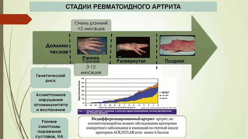 Ранняя стадия ревматоидного артрита