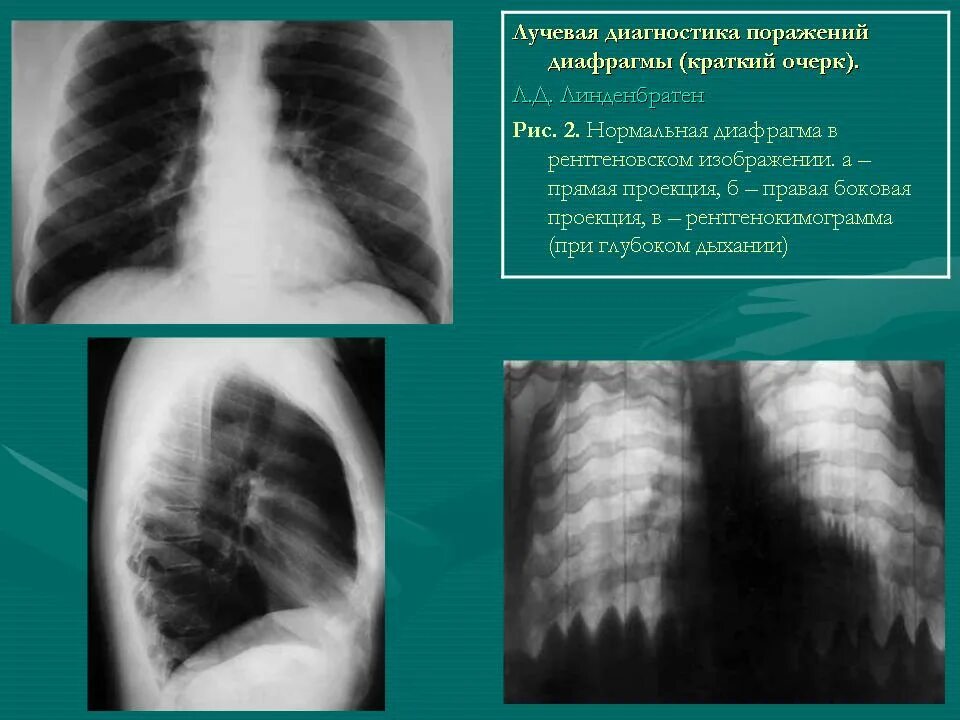 Элевация купола диафрагмы. Релаксация диафрагмы. Релаксация купола диафрагмы рентген. Релаксация купола диафрагмы на кт. Релаксация купола диафрагмы что это такое