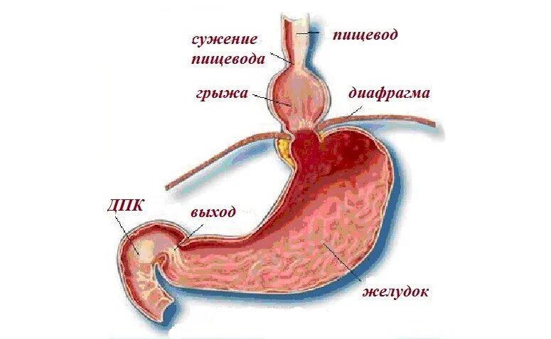 Симптомы грыжи желудка пищевода. Диафрагмальное сужение пищевода. пищевод диафрагмальное сужение грыжа.