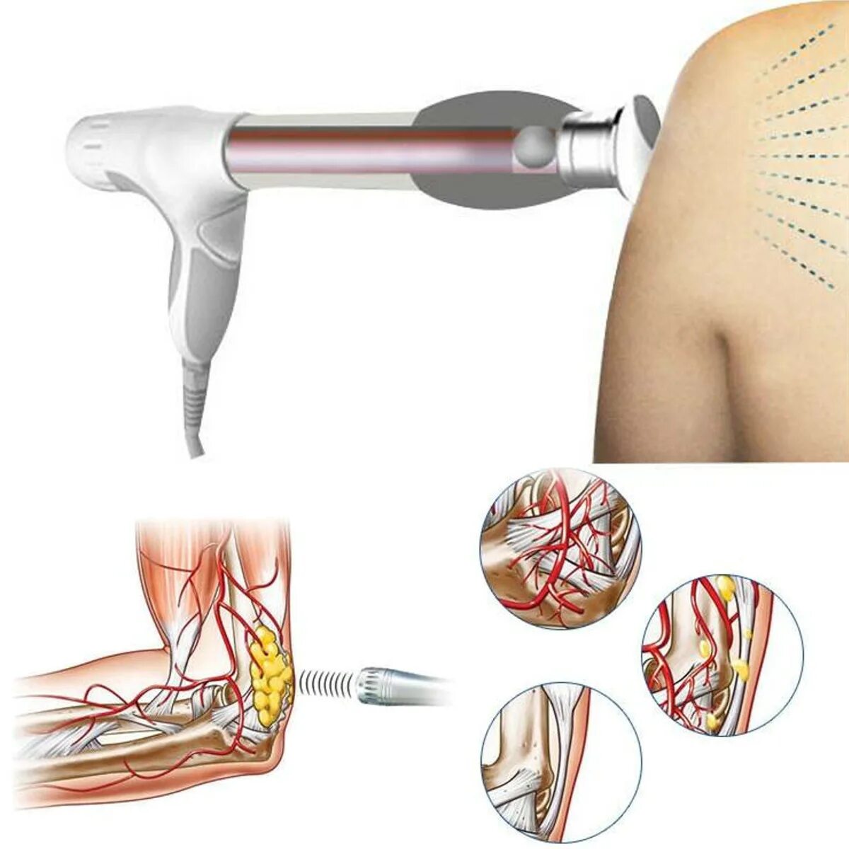 ударно волновая терапия холка