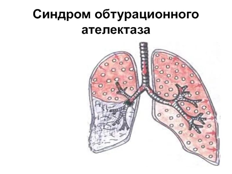 Синдром компрессионного ателектаза. Синдром обтурационного ателектаза. Синдром ателектаза легкого компрессионный. Синдром обтурационного ателектаза пропедевтика. Обтурационный ателектаз легкого