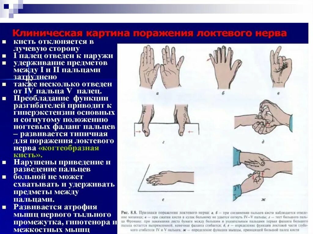лечение лучевого нерва