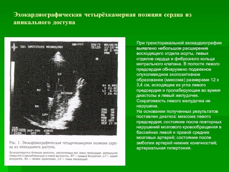 Образование левого предсердия. Миксома левого предсердия на ЭХОКГ. Апикальная позиция четырехкамерная сердца ЭХОКГ. Миксома правого желудочка сердца на УЗИ.