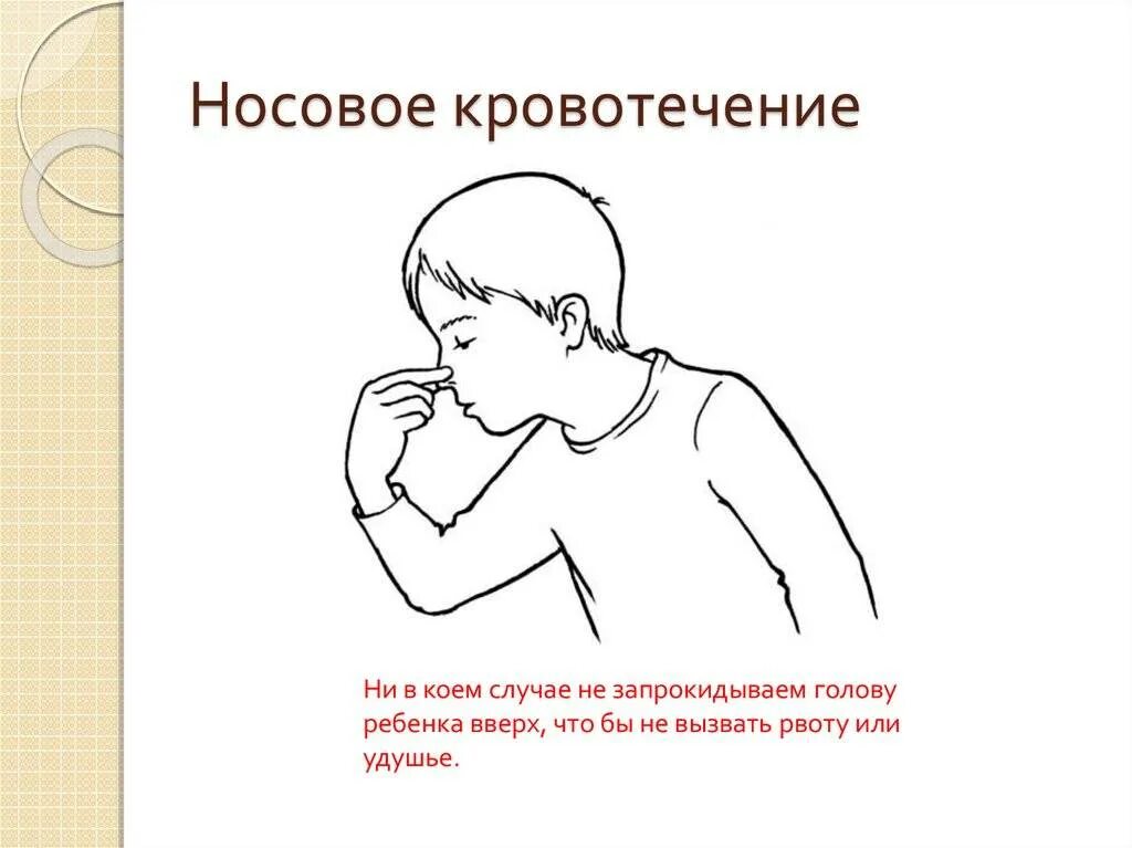 Нлсовоеткровоьечение у детей. Кровотечение из носа у детей.