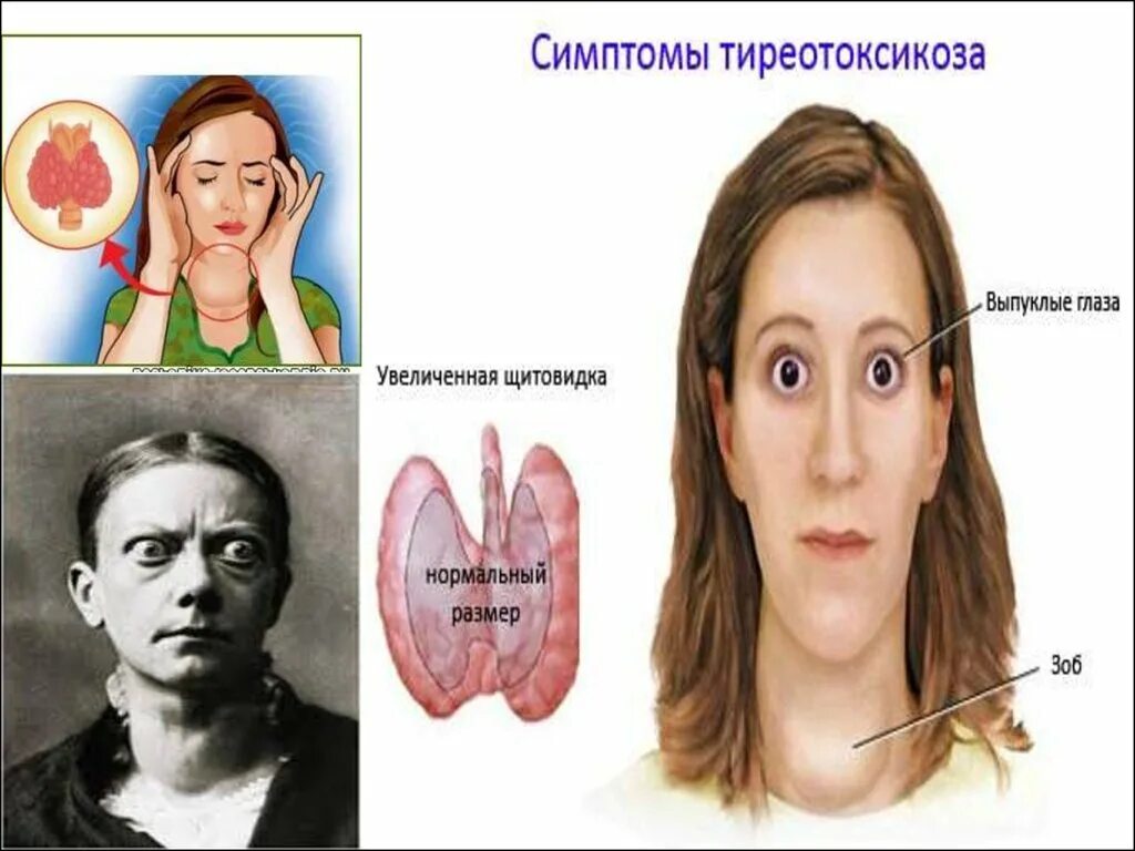 Гипертиреоз dr md ru. Гипертиреоз щитовидной. Щитовидка тиреотоксикоз.