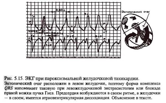 Какой ритм при пароксизмальной тахикардии. Какой ритм при пароксизмальной тахикардии
