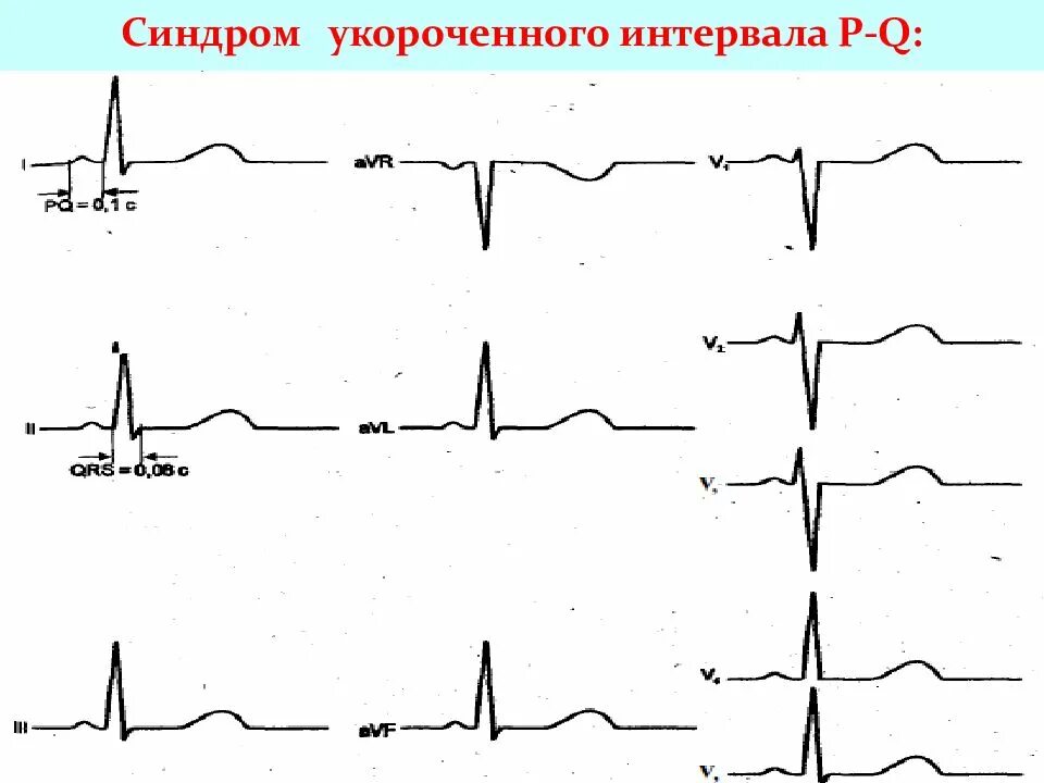 Экг укорочение. Укорочение интервала PQ на ЭКГ. Укороченный интервал PQ на ЭКГ. Синдром укорочения интервала PQ на ЭКГ. Короткий интервал PQ на ЭКГ.