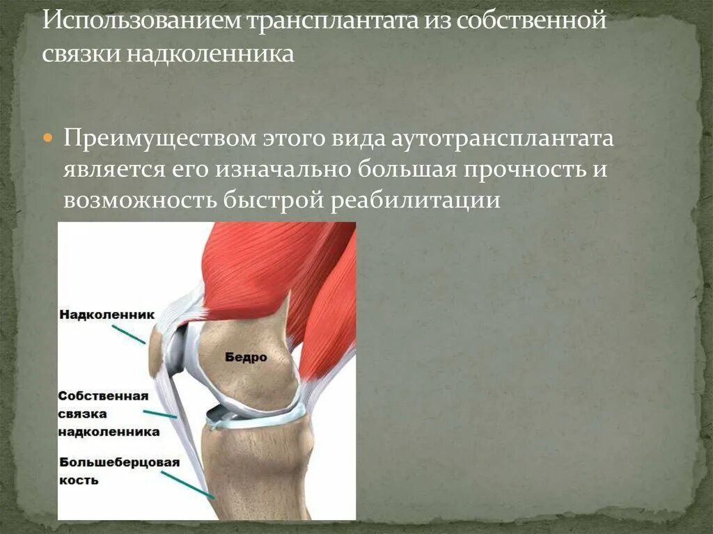 Латерализация надколенника. Собственная связка надколенника. Собственно связка надколенника. Связка удерживающая надколенник. Собюственная связка надколенник.