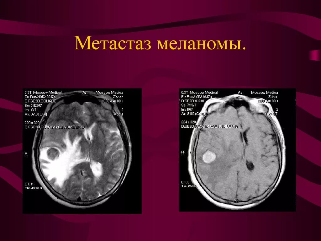 Метастазы в мозг прогноз. Метастазы меланомы в головной мозг кт. Метастатическая меланома. Метастазирование меланомы.