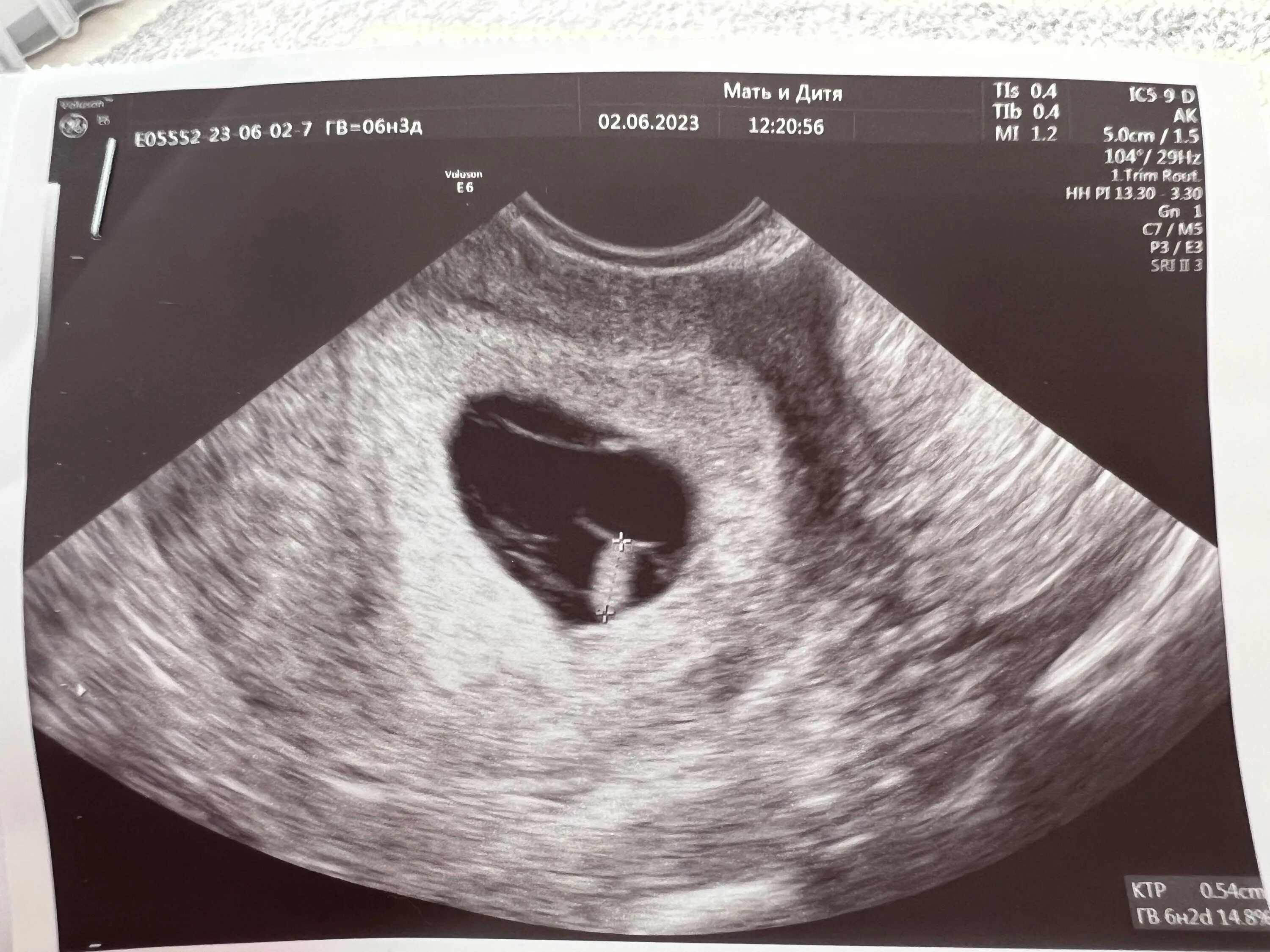 Замершая беременность 18 недель. Неразвивающаяся беременность УЗИ. Замирание беременности. Замершая беременность фото.