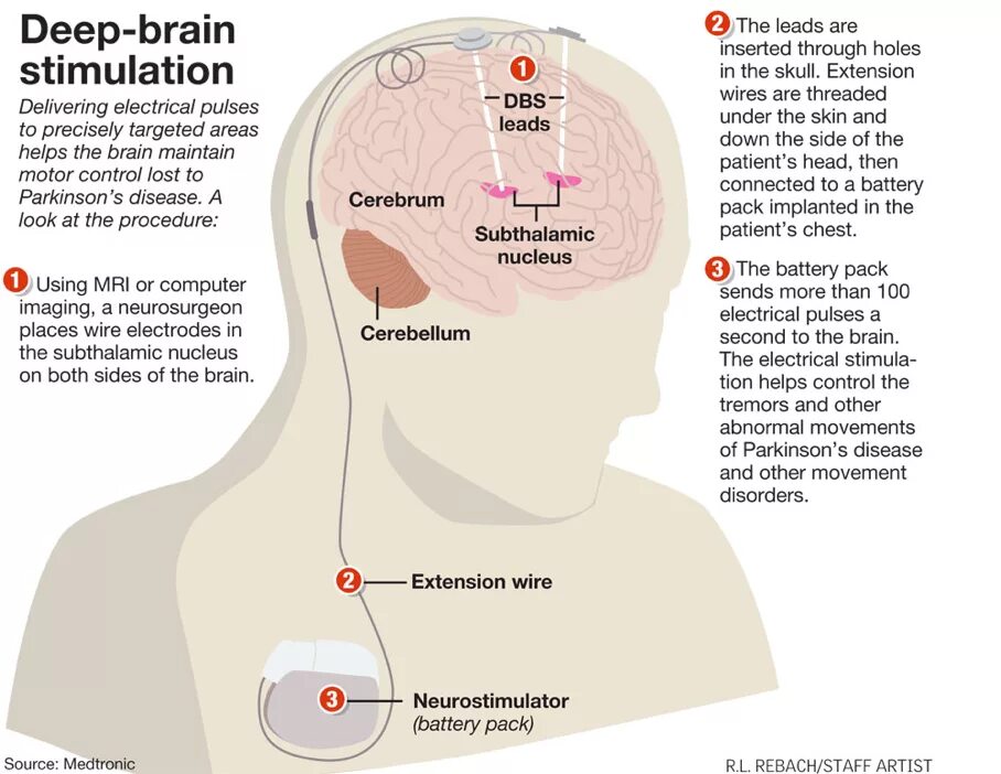 Deep brain. Глубокая стимуляция мозга. Глубинная стимуляция головного мозга. Глубокая стимуляция мозга DBS. Операция Deep Brain stimulation картинка.