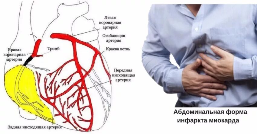 инфаркт миокарда абдоминальная форма клиника. абдоминальная форма инфаркта миокарда причины. инфаркт абдоминальная форма симптомы. абдоминальная форма инфаркта миокарда симптомы. атипичные безболевые формы инфаркта миокарда:.