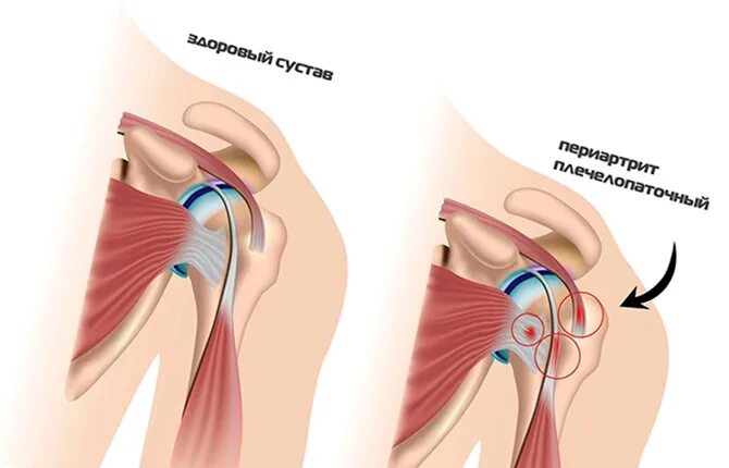Плечевой периартрит что это. Периартрит тазобедренного. Периартрита сумки «гусиной лапки». Периартрит, периартроз.. Плечелопаточный периартрит плечевого сустава.