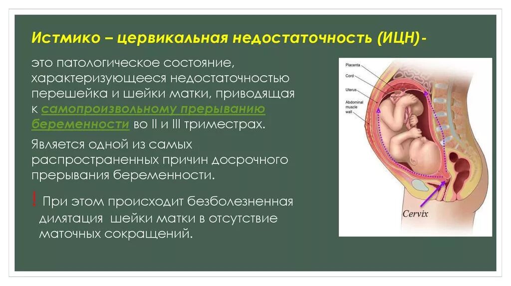 Истмико-цервикальная недостаточность. Цервикальная недостаточность при беременности.