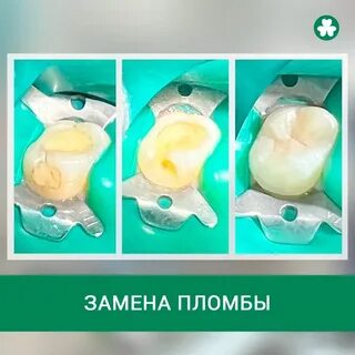 Пломба меняет цвет