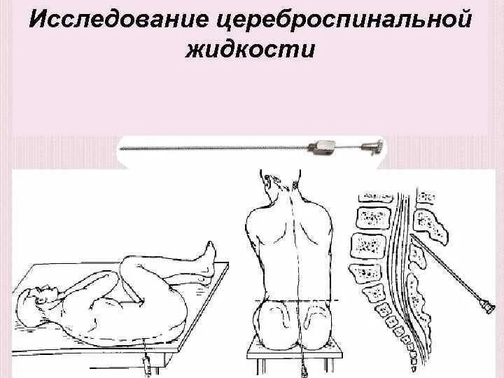 Пункция через задний свод. Спинномозговая пункция рисунок. Спинномозговая пункция техника. Туберкулезный менингит пункция.