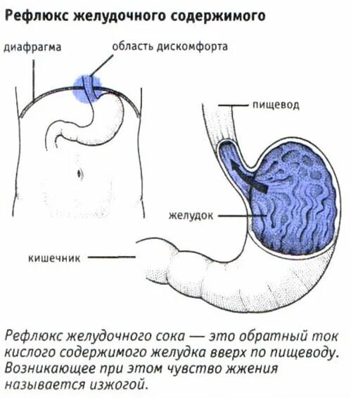 Как избавиться от рефлюкса. Желудочно-пищеводный рефлюкс. Клапан рефлюкс пищевода. Рефлюкс желудочного содержимого в пищевод. Клапан в желудке рефлюкс.