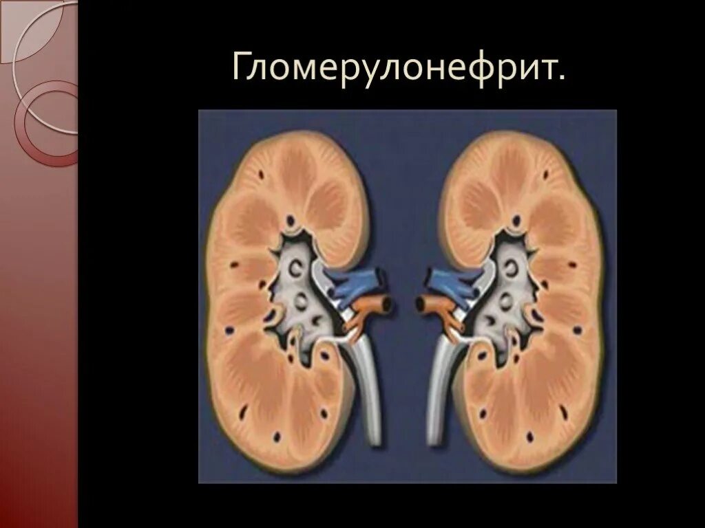 Заболевание почек гломерулонефрит. Поражение почек при гломерулонефрите. Острый гломерулонефрит почка. Хронический гломерулонефрит почка. Почка пораженная гломерулонефритом.