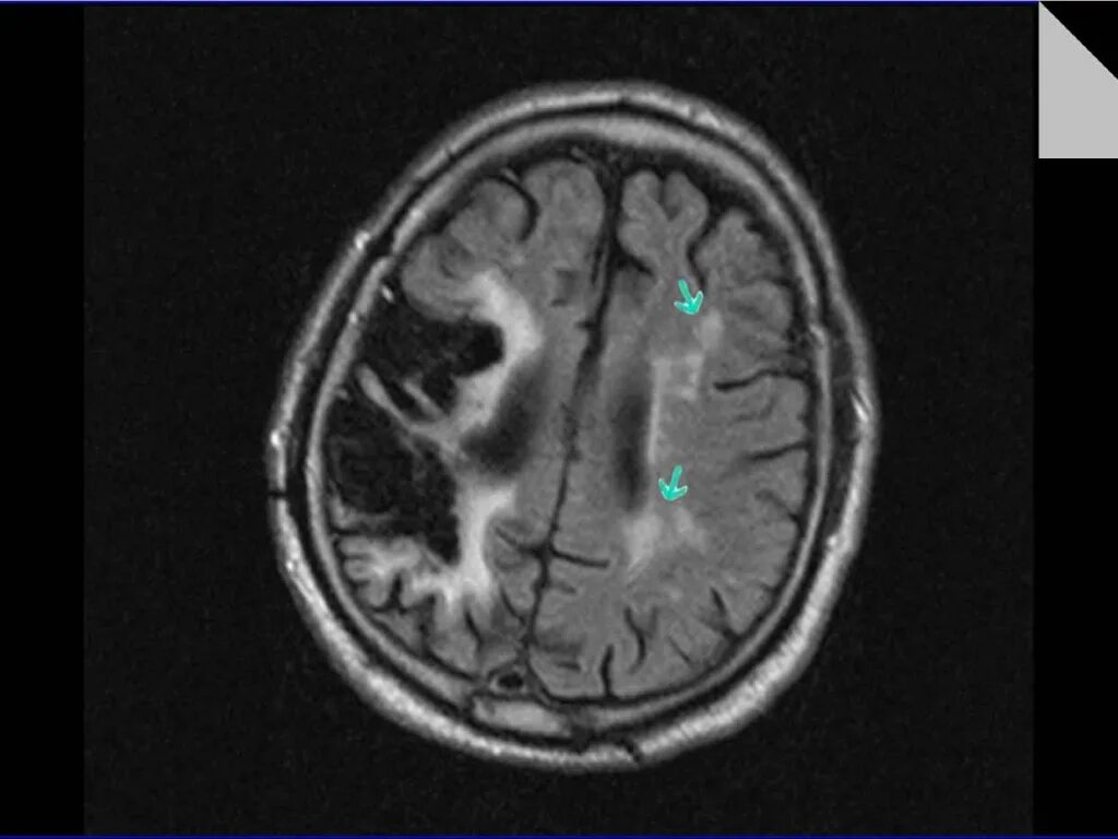 Мелкие очаги в головном мозге