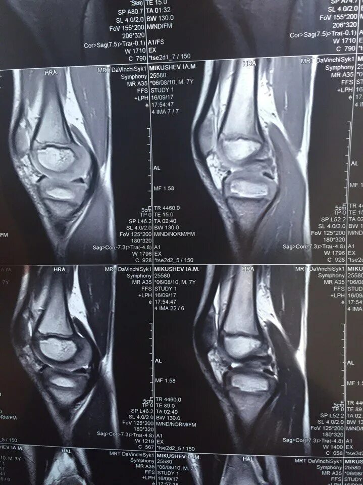 Мрт коленного сустава омс. Мрт коленного сустава. Снимки мрт коленного сустава. Мрт снимок здорового колена.
