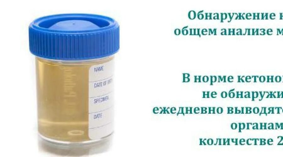 Повышенные кетоны в моче. Ацетон в моче 8 ммоль/л у ребенка. Исследование мочи на кетоновые тела. Кетоны в моче. Анализ мочи на кетоновые тела.