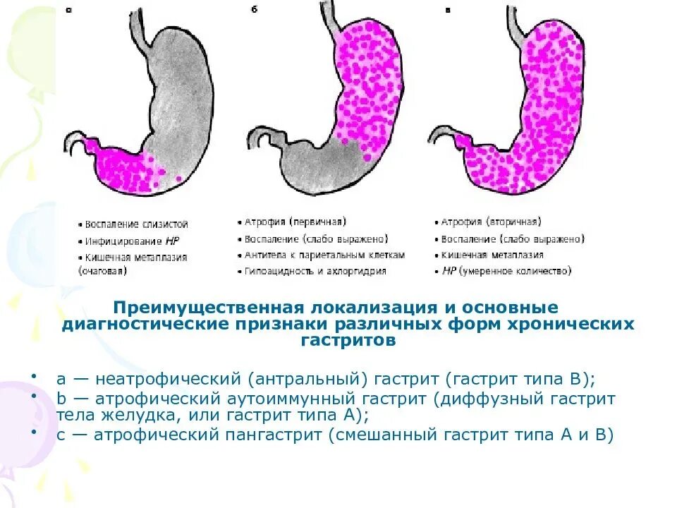 Ригидный антральный гастрит схема. Хронический неактивный антральный гастрит. Хронический атрофический антральный гастрите желудка. Хронический антральный гастрит (Тип б).