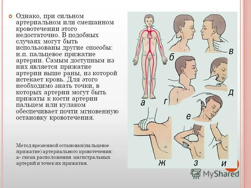 Помощь при смешанном кровотечении. Смешанное кровотечение кровотечение способы остановки. Сиешанноекровотечение. Смешанное кровотечение ПМП. Точки остановки артериального кровотечения.