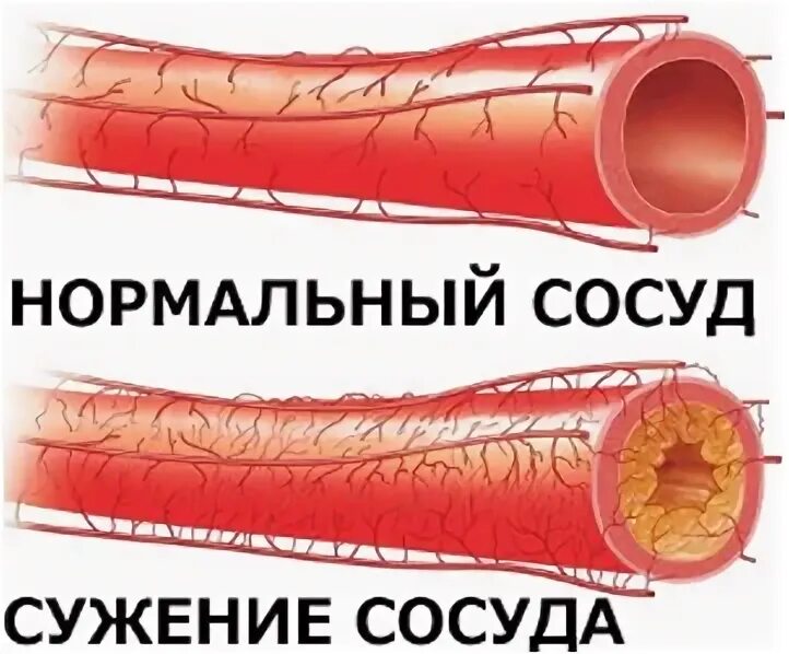 что делать если сосуды сужены