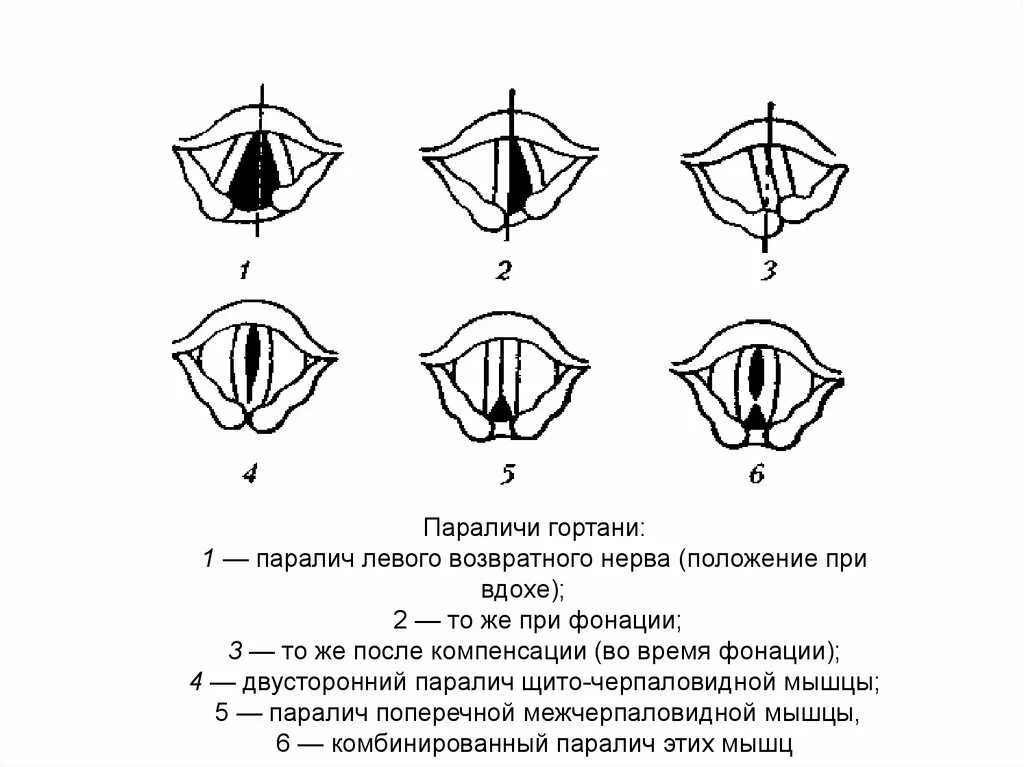 На рисунке изображены различные положения голосовых связок. Положение голосовых связок при параличах гортани. Положение голосовых связок при парезе. Парез голосовых связок кт. Порез голосовыз связок.