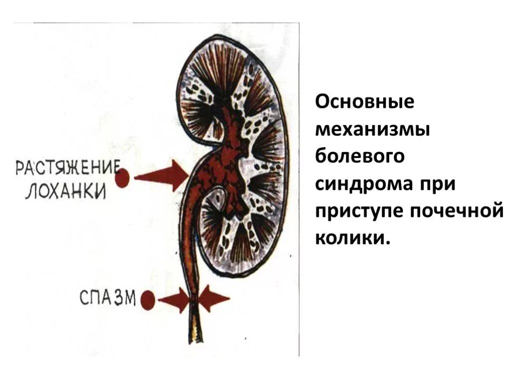 При почечной колике возможна. Синдромы болезней почек. Механизм боли при почечной колике. Синдромы при почечной колике. Синдром почечной колики.