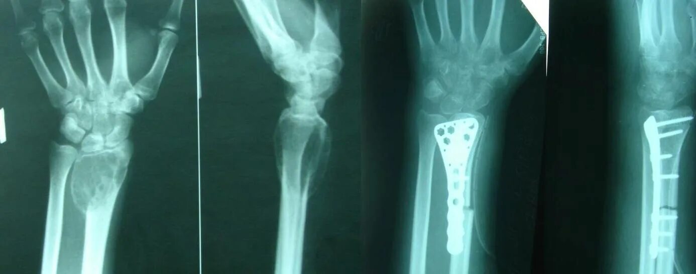 Остеосинтез лучезапястного сустава. Гигантоклеточная опухоль кости рентген. Перелом пястной кости остеосинтез. Гигантоклеточная опухоль фаланги рентген.