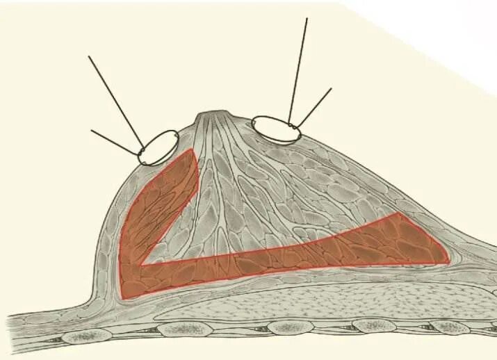 Операция мастопексия Якорная. Коррекция ареолярного комплекса. Ареолярная мастопексия.