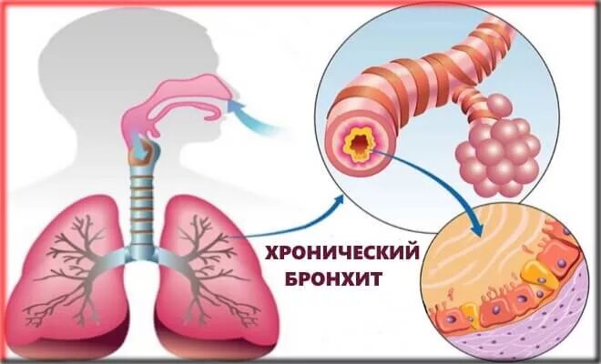 Первичный бронхит. Профилактика бронхита. Профилактика острого бронхита.