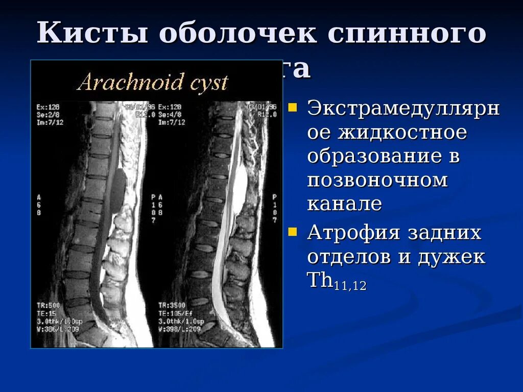 Киста конуса спинного мозга мрт. Опухоль корешка спинного мозга. Арахноидальная киста спинномозгового канала. Отек позвоночника после операции